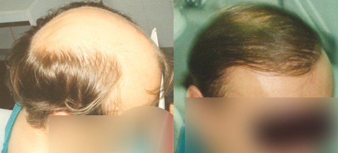 Transplantace vlasů  